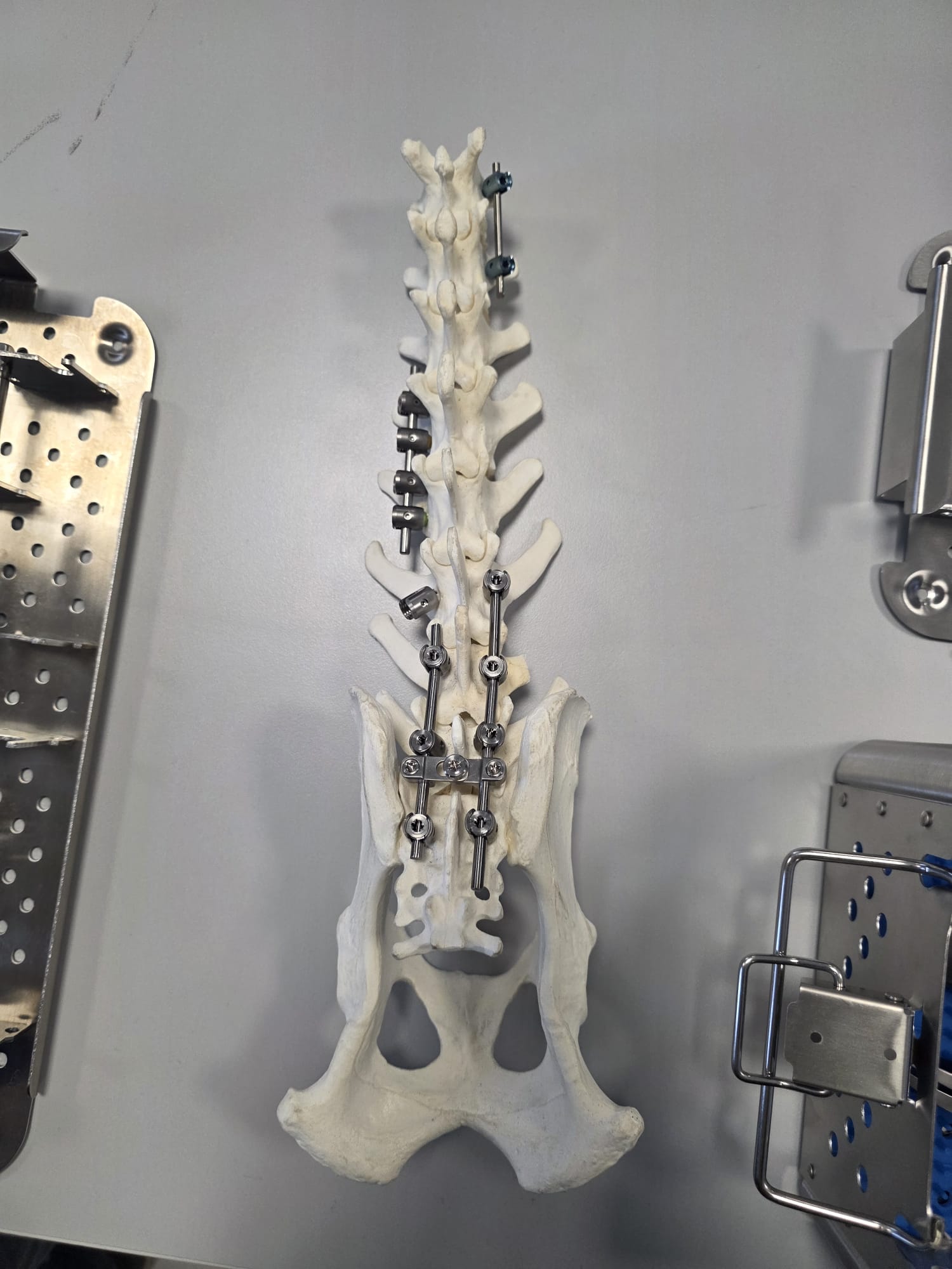 Colonna vertebrale con strumentazione chirurgica di stabilizzazione montata